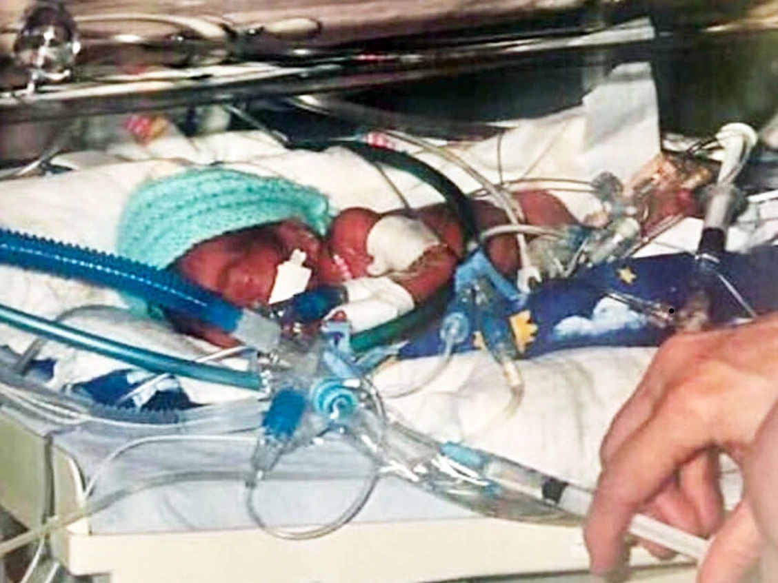 Devlin DeFrancesco as a premature newborn in neonatal intensive care at Sunnybrook Health Science Centre